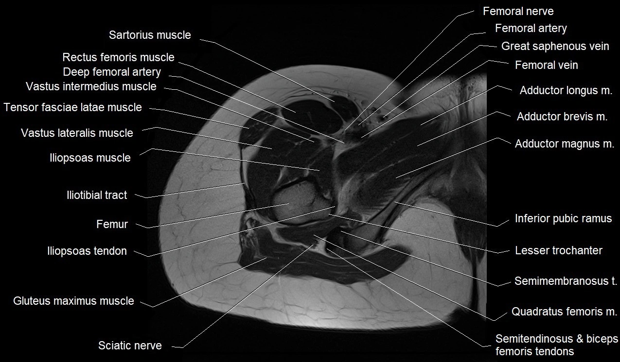 MRI thigh cross sectional anatomy image 13.webp